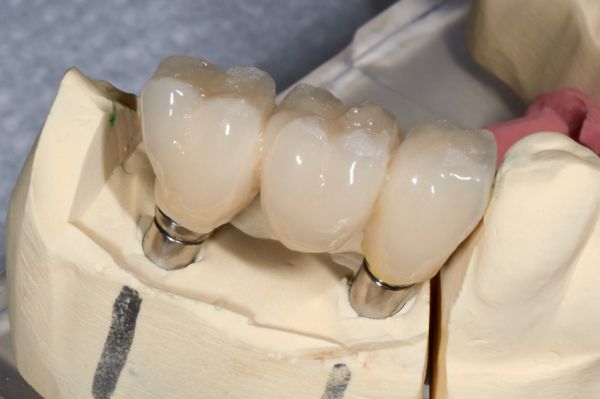Hogyan pótoljuk elveszített fogainkat?