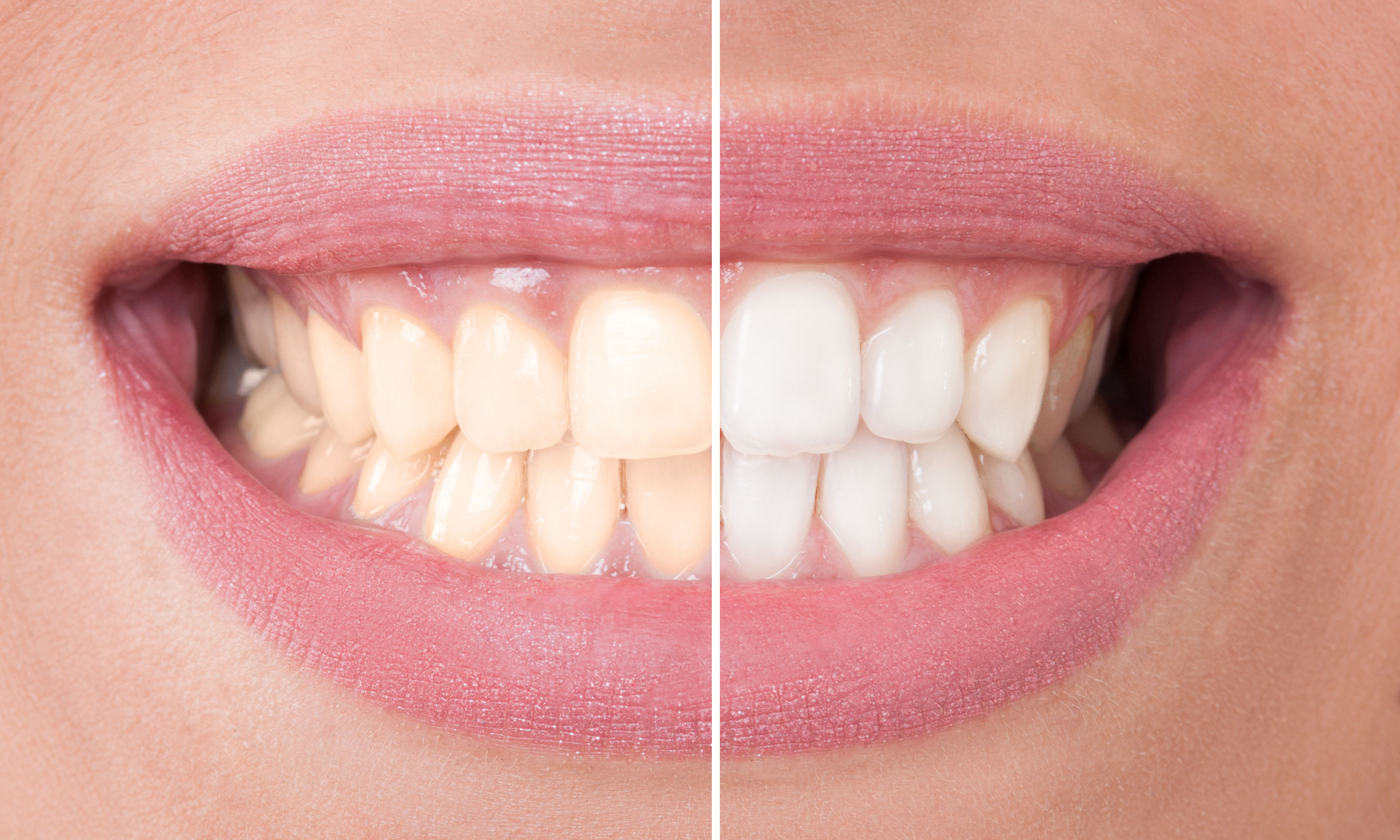 6 meglepő dolog, ami miatt nem elég fehér a fogad